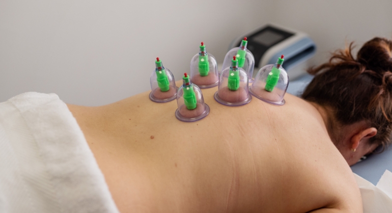 best acupuncture oc cupping