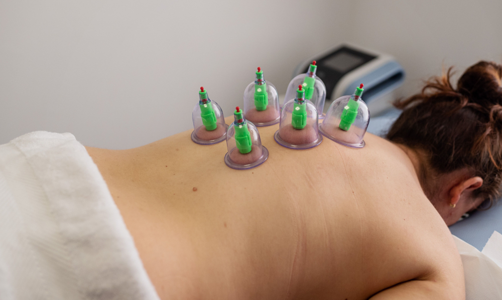 best acupuncture oc cupping