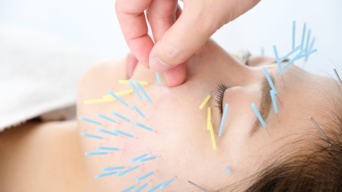 how does acupuncture help relieve headaches and migraines