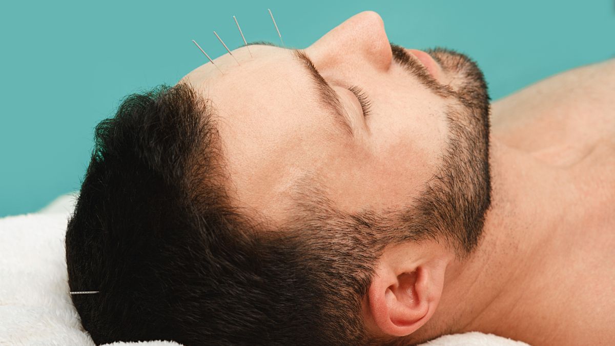 how does acupuncture help relieve headaches and migraines