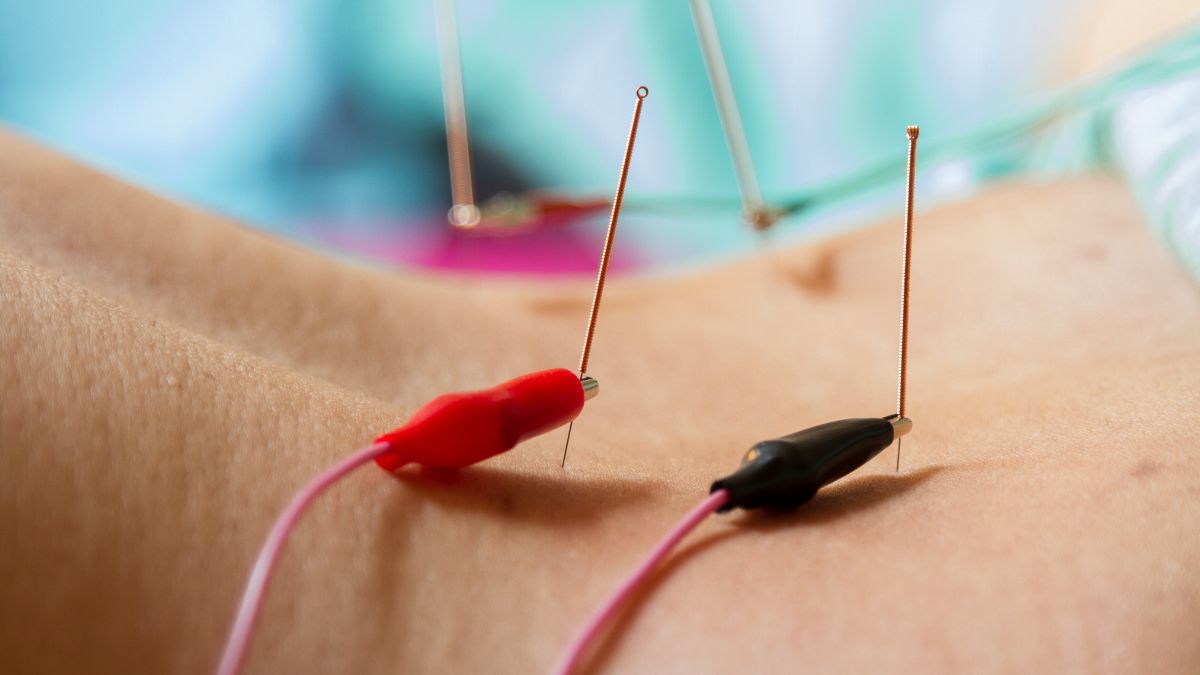 what are the different acupuncture techniques and their benefits