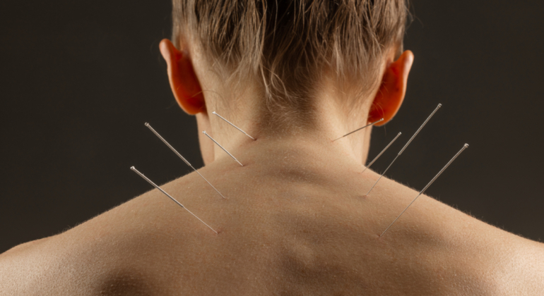 rise acupuncture orange county ca