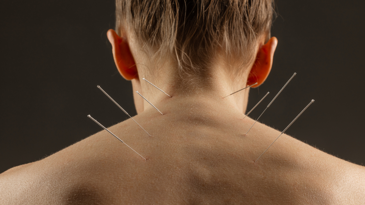 rise acupuncture orange county ca