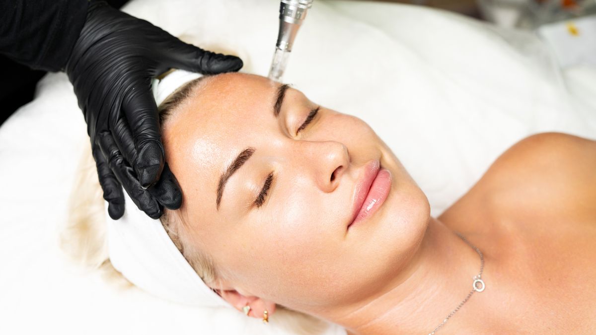 can microneedling reduce acne scars and sun damage over time