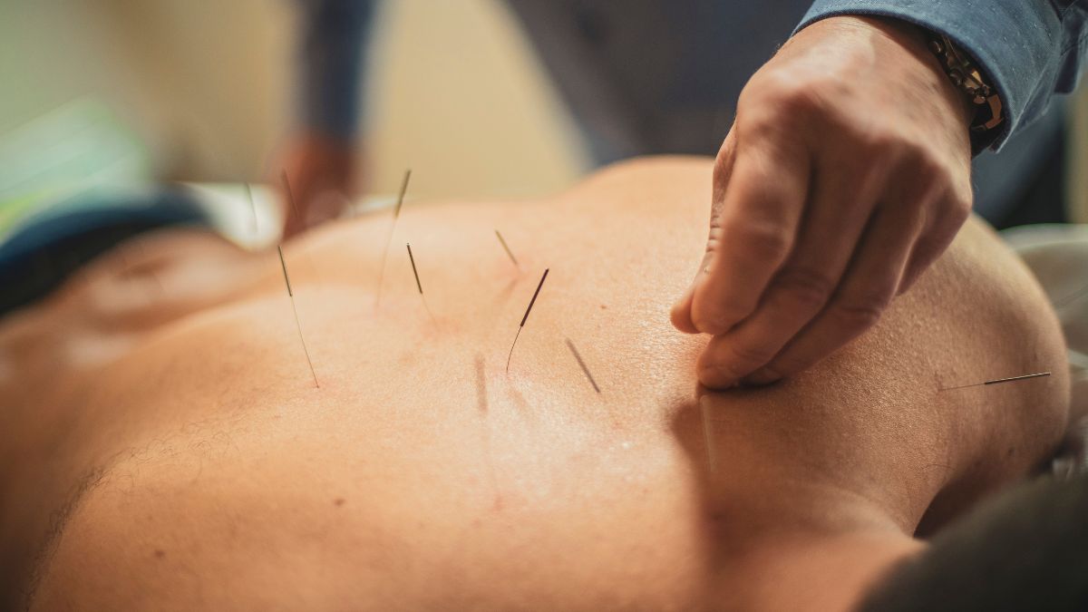 can acupuncture help relieve back pain naturally