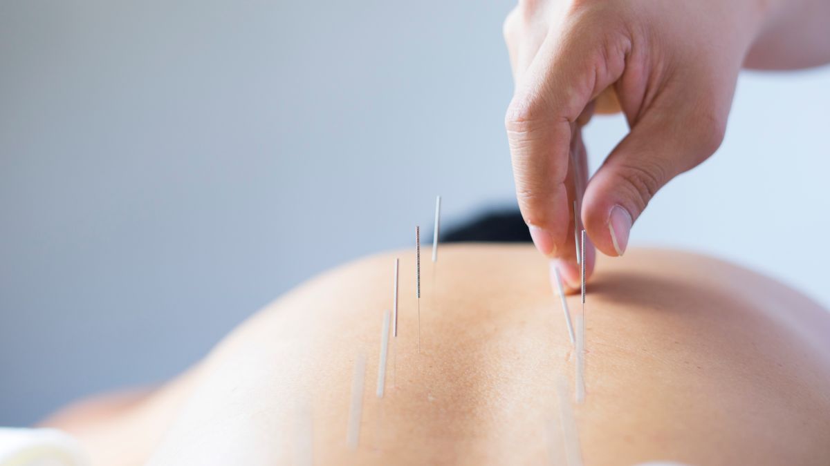 acupuncture for back pain in orange county ca