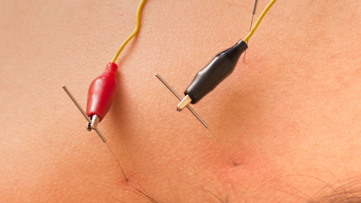 what should you expect after neuropuncture session